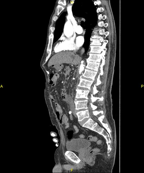 File:Aortoenteric fistula (Radiopaedia 84308-99603 C 167).jpg