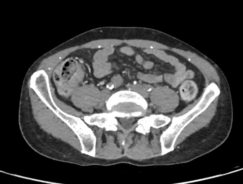 Aortoiliac occlusive disease (Radiopaedia 89182-106053 A 44).jpg