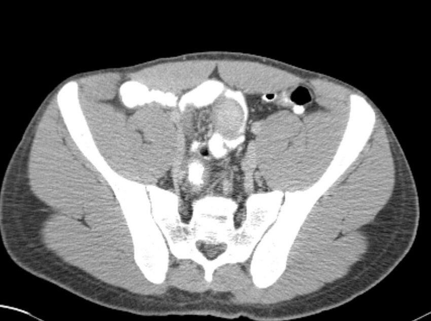 Appendicitis and incidental foregut duplication cyst (Radiopaedia 52962-58916 A 73).jpg