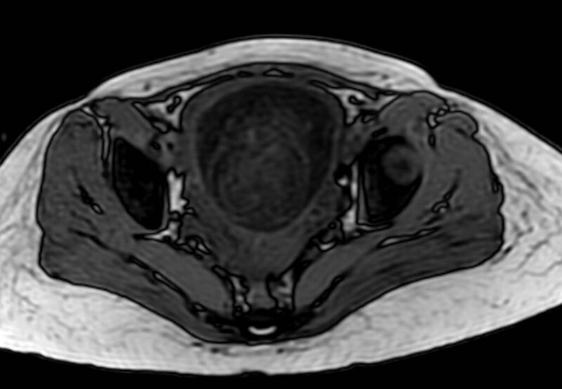 File:Appendicitis in gravida (MRI) (Radiopaedia 89433-106395 D 61).jpg