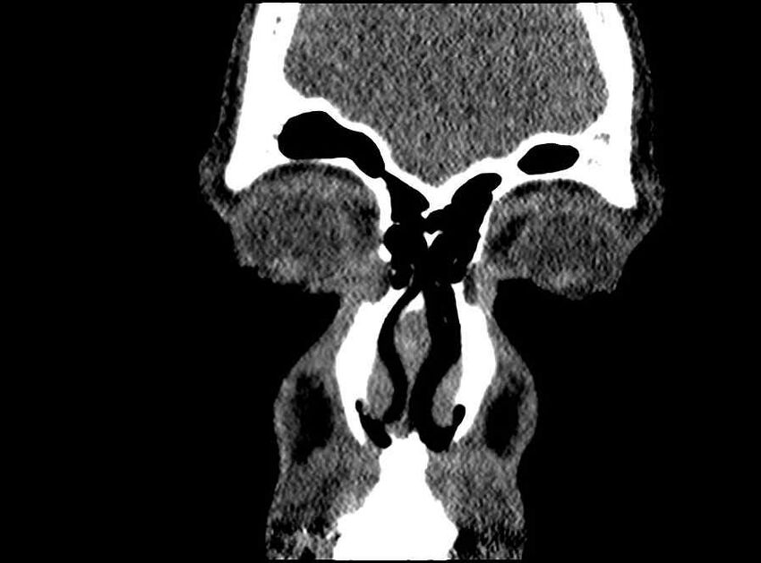 Arachnoid cyst- extremely large (Radiopaedia 68741-78450 Coronal bone window 69).jpg