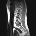 Arachnoid cyst - spinal (Radiopaedia 66835-76157 Sagittal T1 10).jpg