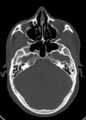 Arrow injury to the head (Radiopaedia 75266-86388 Axial bone window 56).jpg