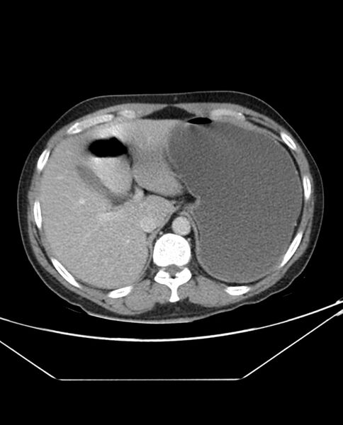 File:Arterial occlusive mesenteric ischemia (Radiopaedia 84641-100054 A 23).jpg