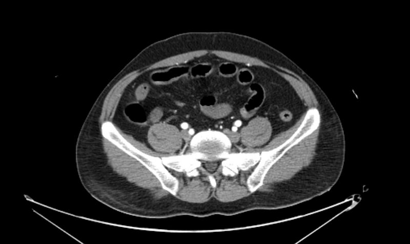 File:Arterial occlusive mesenteric ischemia (Radiopaedia 84641-100060 A 95).jpg
