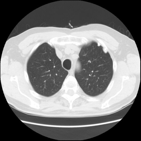 File:Asbestos-related pleural plaques (Radiopaedia 39069-41255 Axial lung window 16).jpg