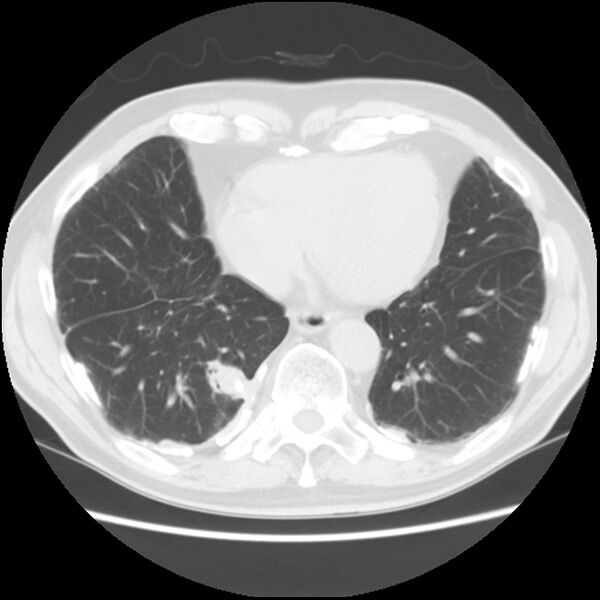 File:Asbestos-related pleural plaques (Radiopaedia 39069-41255 Axial lung window 52).jpg