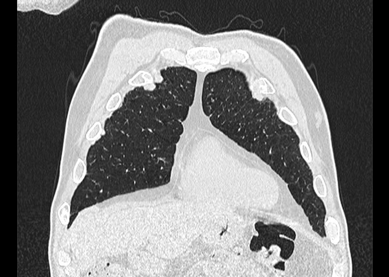 File:Asbestos pleural placques (Radiopaedia 57905-64872 Coronal lung window 43).jpg