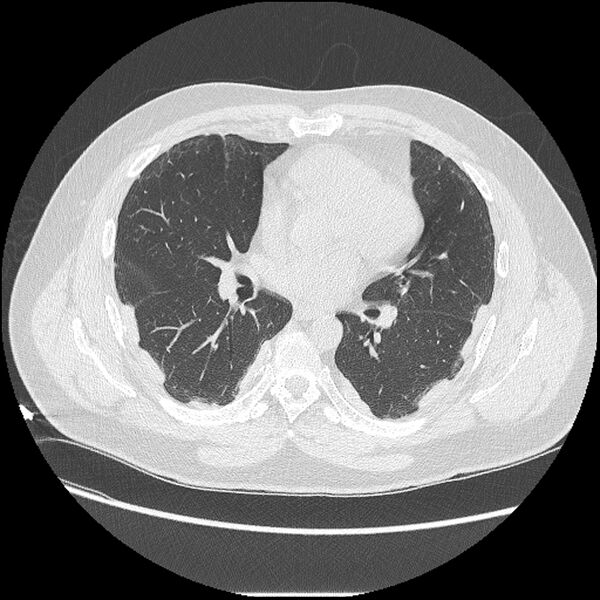 File:Asbestosis (Radiopaedia 45002-48961 Axial lung window 27).jpg
