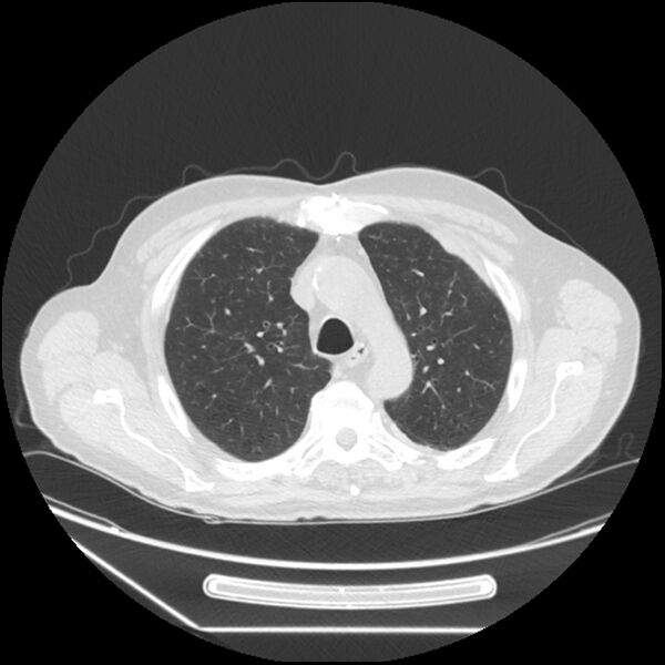 File:Asbestosis complicated by lung cancer (Radiopaedia 45834-50116 Axial lung window 19).jpg