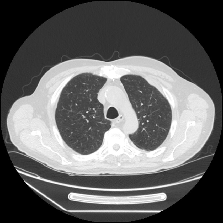 Asbestosis complicated by lung cancer (Radiopaedia 45834-50116 Axial lung window 19).jpg