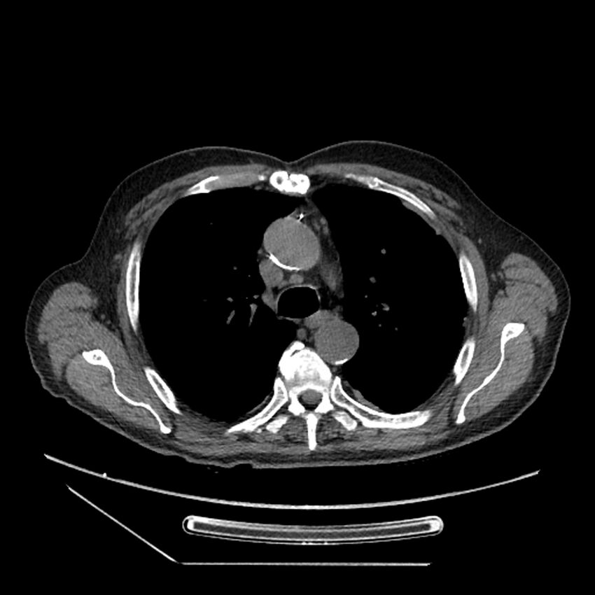 Asbestosis complicated by lung cancer (Radiopaedia 45834-50116 Axial non-contrast 22).jpg