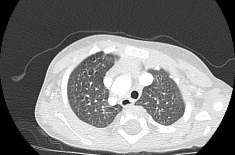 File:Asplenia syndrome (Radiopaedia 73083-83792 Axial lung window 13).jpg