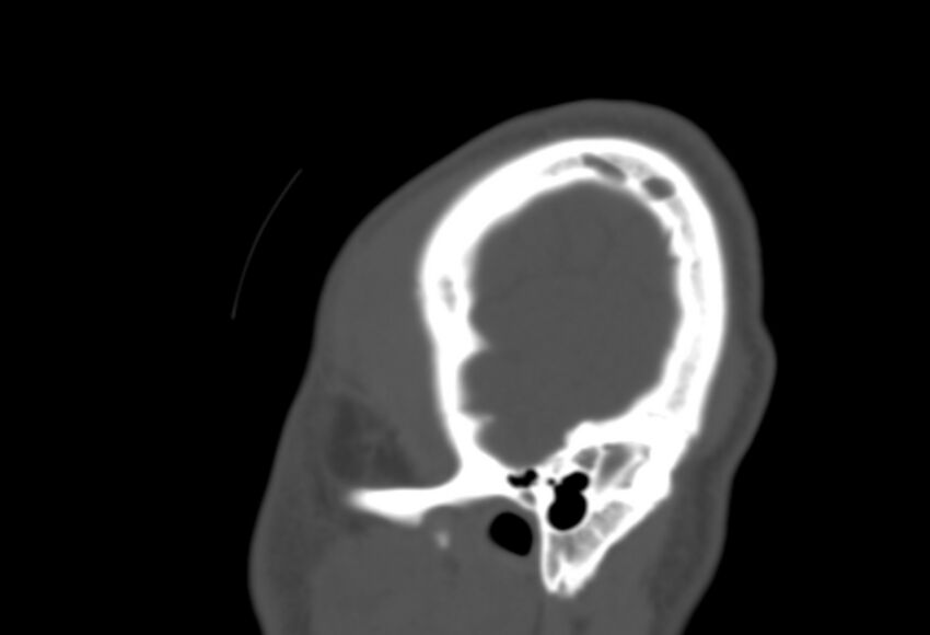 Asymptomatic occipital spur (Radiopaedia 87753-104201 Sagittal bone window 296).jpg