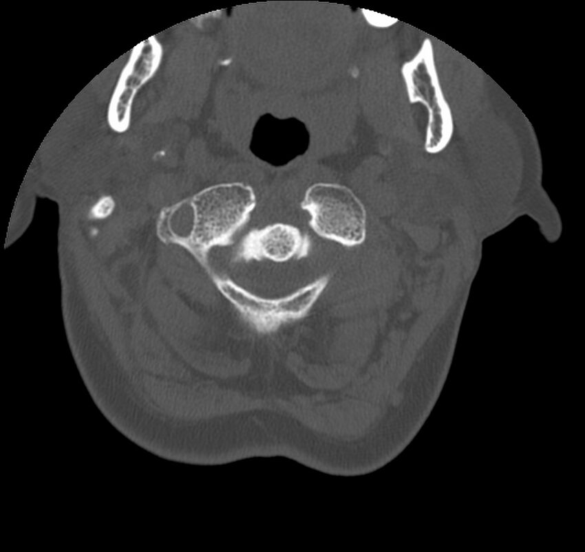 Atlanto-occipital assimilation with basilar invagination (Radiopaedia 70122-80188 Axial bone window 24).jpg