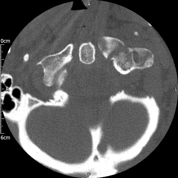 File:Atlas fracture with Currarino type A congenital defect (Radiopaedia 71747-82144 Axial bone window 32).jpg