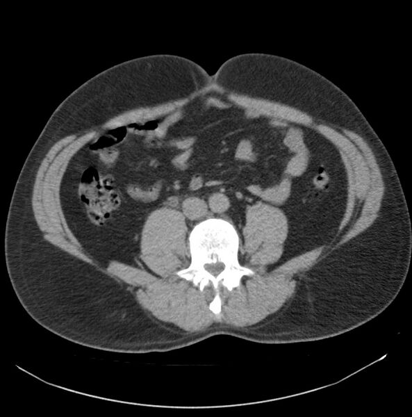File:Atrophic kidney due to severe chronic obstructive hydronephrosis (Radiopaedia 40828-43474 Axial non-contrast 19).jpg
