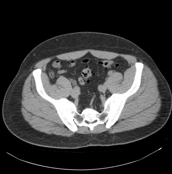 File:Atrophic kidney due to severe chronic obstructive hydronephrosis (Radiopaedia 40828-43474 Axial non-contrast 34).jpg