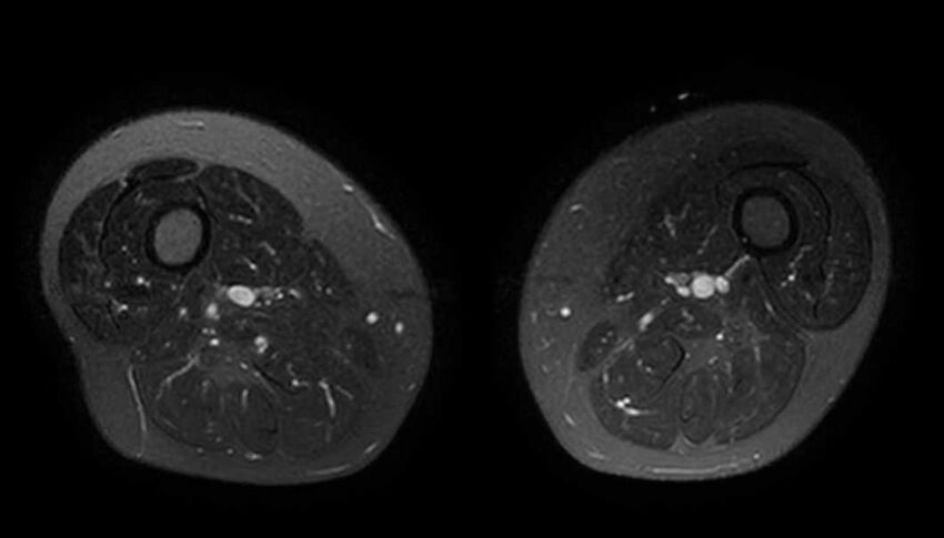 Atypical lipomatous tumor - thigh (Radiopaedia 68975-78734 Axial T2 fat sat 40).jpg