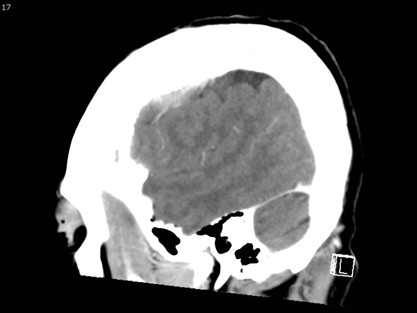 Atypical meningioma - intraosseous (Radiopaedia 64915-73867 F 16).jpg