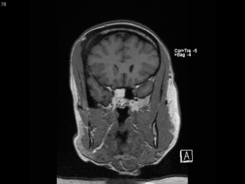 Atypical meningioma - intraosseous (Radiopaedia 64915-74572 Coronal T1 78).jpg