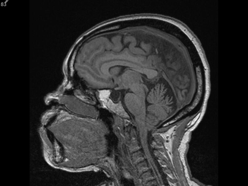 File:Atypical meningioma - intraosseous (Radiopaedia 64915-74572 Sagittal T1 83).jpg