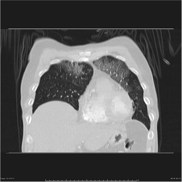 File:Atypical pneumonia - Q fever (Radiopaedia 21993-21989 C 8).jpg