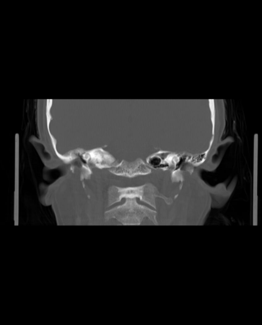 Automastoidectomy with labyrinthine fistula (Radiopaedia 84143-99411 Coronal non-contrast 90).jpg