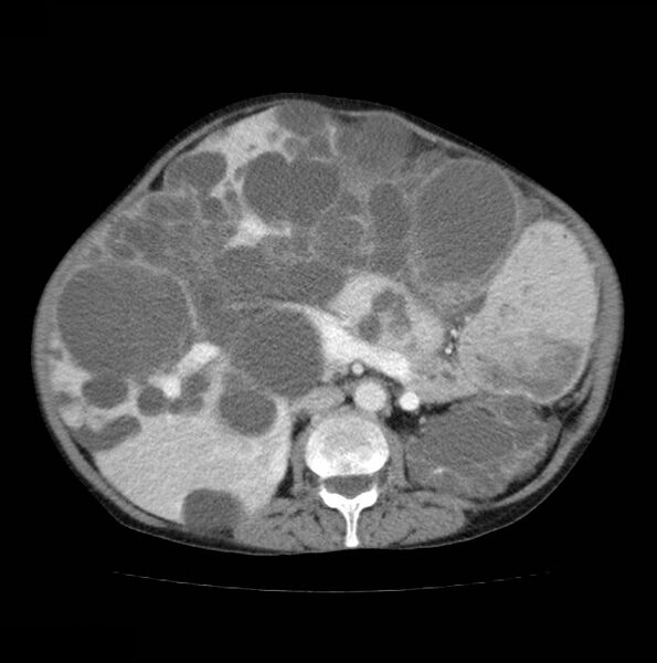 File:Autosomal dominant polycystic kidney disease (Radiopaedia 16777-16490 A 26).jpg
