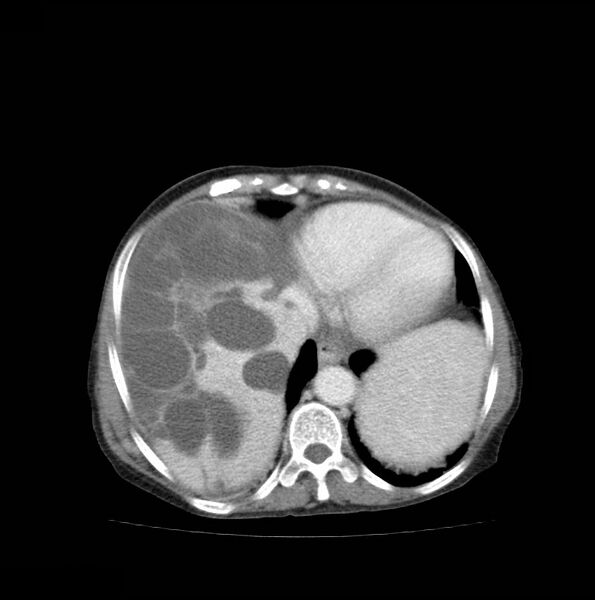 File:Autosomal dominant polycystic kidney disease (Radiopaedia 16777-16490 A 8).jpg