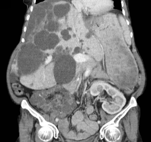 File:Autosomal dominant polycystic kidney disease (Radiopaedia 16777-16490 B 21).jpg