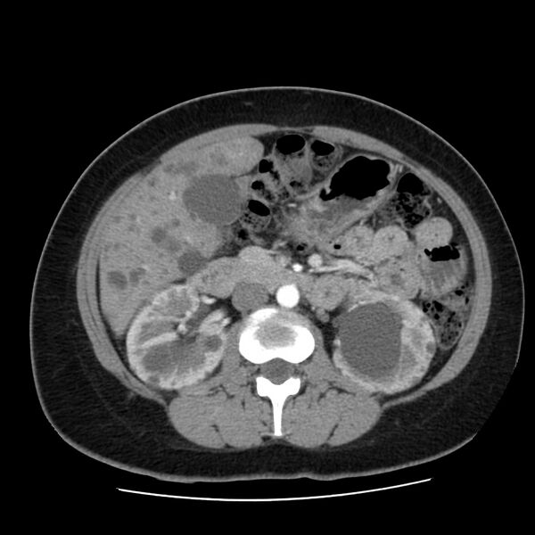 File:Autosomal dominant polycystic kidney disease (Radiopaedia 23061-23093 B 30).jpg