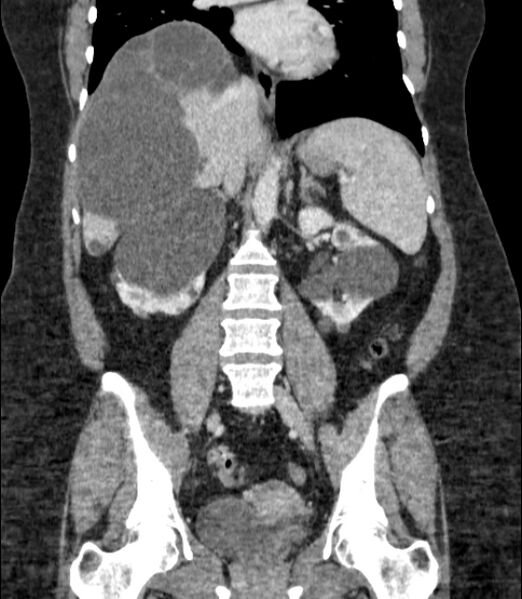 File:Autosomal dominant polycystic kidney disease (Radiopaedia 57124-64017 B 46).jpg