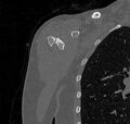 Avulsion fracture - greater tuberosity of humerus (Radiopaedia 71216-81514 Coronal bone window 5).jpg