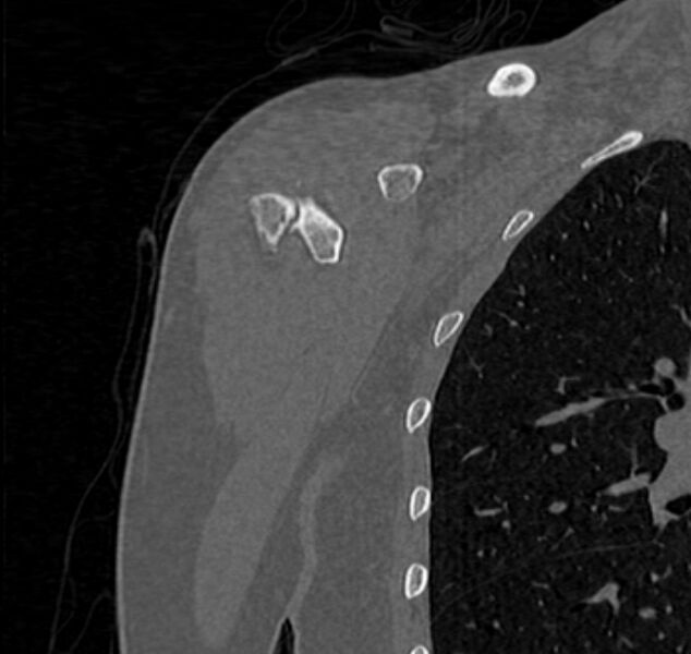 File:Avulsion fracture - greater tuberosity of humerus (Radiopaedia 71216-81514 Coronal bone window 5).jpg