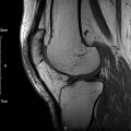 Avulsion fracture of the fibular head (Radiopaedia 74804-85808 D 21).jpg