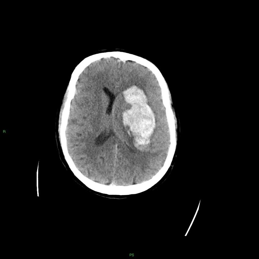 Basal ganglia hemorrhage (Radiopaedia 58349-65472 Axial non-contrast 27).jpg