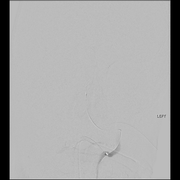 File:Basilar tip thrombus with endovascular clot retrieval (Radiopaedia 46320-50726 D 7).png
