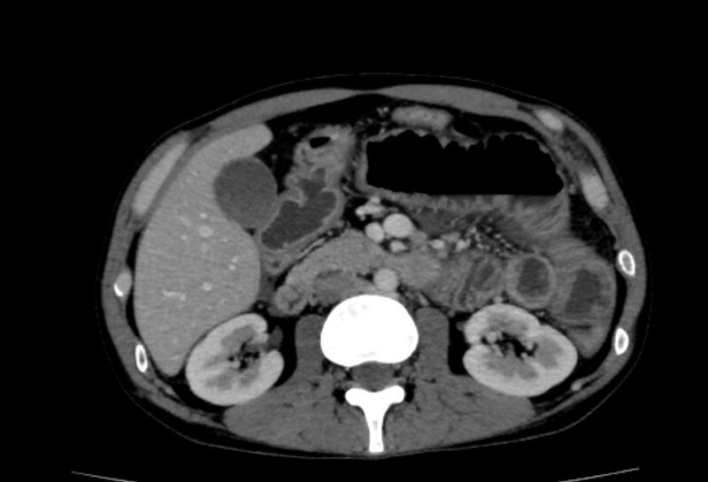 File:Behçet's disease- abdominal vasculitis (Radiopaedia 55955-62570 A 31).jpg
