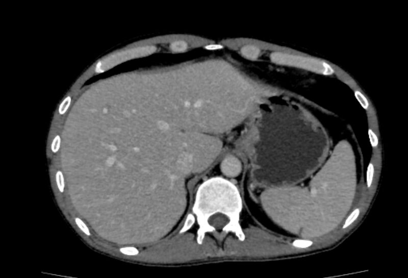 File:Behçet's disease- abdominal vasculitis (Radiopaedia 55955-62570 A 9).jpg