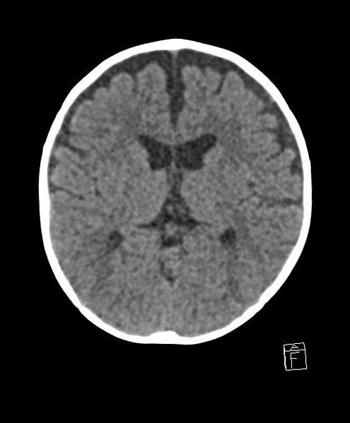 File:Benign enlargement of subarachnoid spaces in infancy (BESS) (Radiopaedia 87459-103795 Axial non-contrast 43).jpg