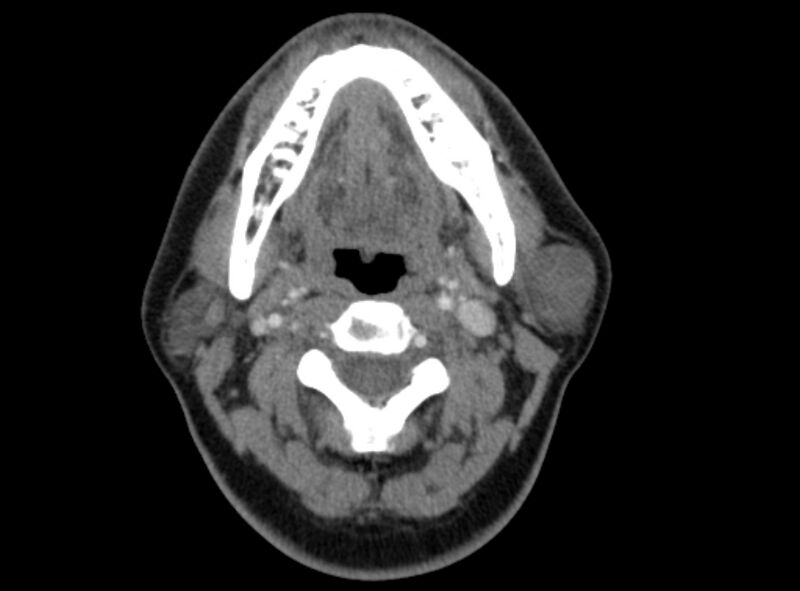 File:Benign mixed salivary tumor of the parotid gland (Radiopaedia 35261-36792 A 23).jpg