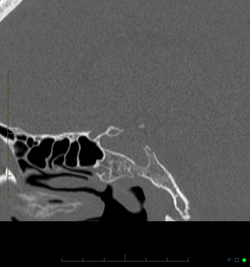 Benign notochordal cell tumor (probable) (Radiopaedia 65475-74546 Sagittal bone window 35).jpg