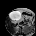 Benign seromucinous cystadenoma of the ovary (Radiopaedia 71065-81300 B 35).jpg