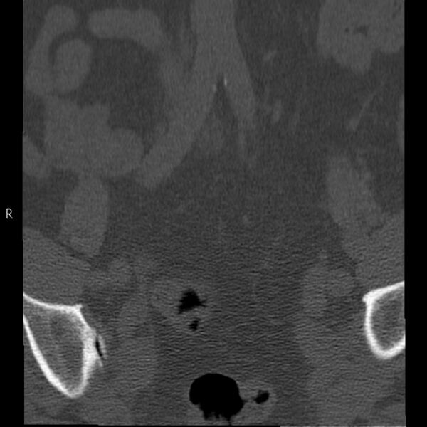 File:Bertolotti syndrome (Radiopaedia 24864-25128 Coronal bone window 1).jpg