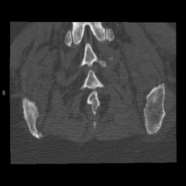 File:Bertolotti syndrome (Radiopaedia 24864-25128 Coronal bone window 43).jpg