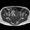 Bicornuate uterus (Radiopaedia 61974-70046 Axial T1 28).jpg