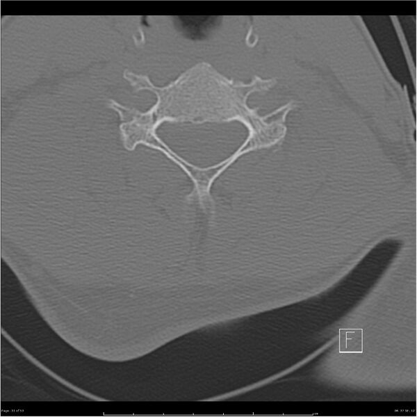 File:Bilateral cervical ribs (Radiopaedia 25868-26017 Axial bone window 31).jpg