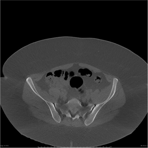 File:Bilateral lumbar ribs (Radiopaedia 25862-26010 bone window 47).jpg