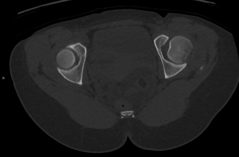 File:Bilateral mature cystic ovarian teratoma (Radiopaedia 88821-105592 Axial bone window 40).jpg